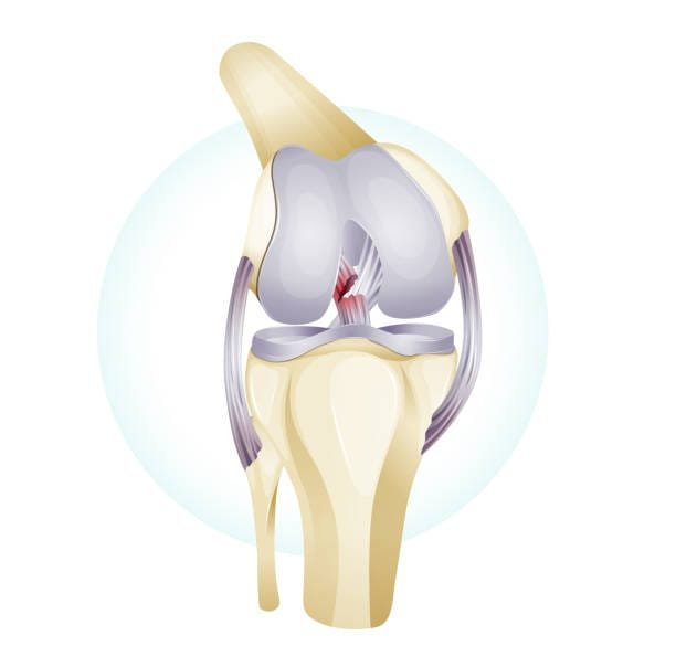 Meniscus Tear